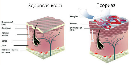 лекарство от псориаза