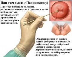 диагностика рака шейки матки в Израиле